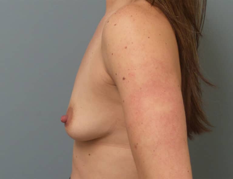 Before Image: Breast Augmentation - left-side