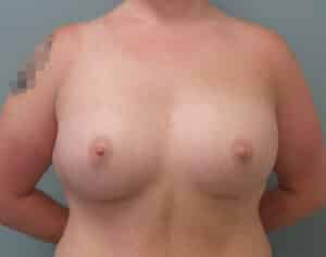 After Image: Breast Augmentation