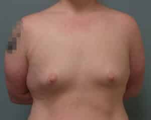 Before Image: Breast Augmentation