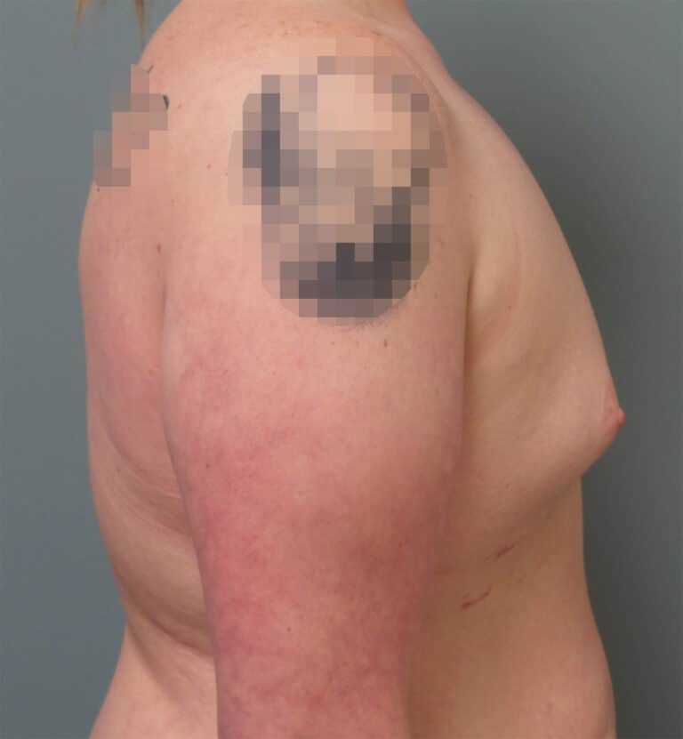 Before Image: Breast Augmentation - right-side